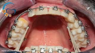 درمان تنگی فک بالا با ارتودنسی دیمون | دکتر داوودیان