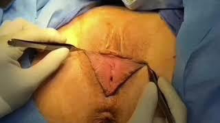 Revision Labiaplasty