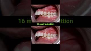 Braces for buck teeth, 16 months #braces #orthodontist #dentaltreatment #dentist