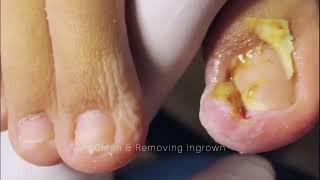 Cut Big Dirty Ingrown Toenail 512 剪大脏向内生长脚趾甲 #health #shorts