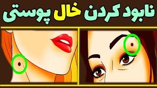 از بین بردن خال های صورت | برداشتن خال صورت | برداشتن خال گوشتی