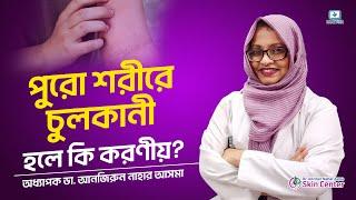 পুরো শরীরে চুলকানী #itchingproblem #itchingtreatment