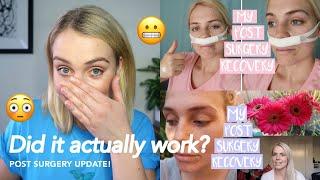 WHAT TO EXPECT AFTER NASAL SURGERY 2021 | Three Years Post-Sinus (Septoplasty) Operation Recovery!