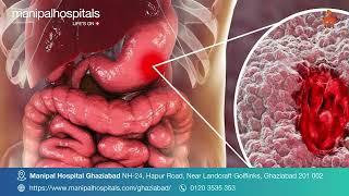 Inflammatory Bowel Disease | Dr. Manish Kak | Manipal Hospital Ghaziabad | IBD Disease