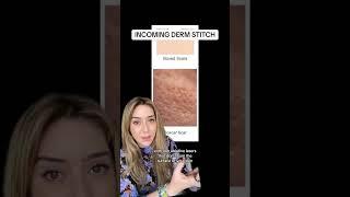 Treating Acne Scars Part 2 #shorts