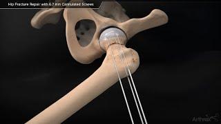 Hip Fracture Repair with 6.7 mm Cannulated Screws