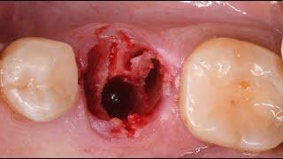 Immediate Implant Placement: Mandibular Molar