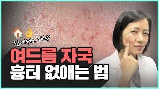 의사가 알려주는 여드름 자국 흉터 없애는법 |  홈케어, 예방법