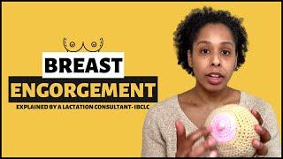 BREAST ENGORGEMENT Postpartum | Causes of Breast Engorgement, Symptoms, Effective Treatments