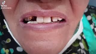 Dental Bridge | Smile Makeover in Lahore (Before/After)