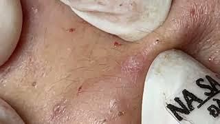 Relax Skincare Everyday with Acne Blackheads Treatment Spa #9783