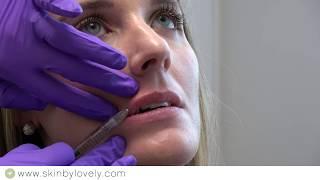 Juvederm Volbella -- Lip Enhancement Demo -- Skin by Lovely