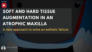 Soft and hard tissue augmentation in an atrophic maxilla