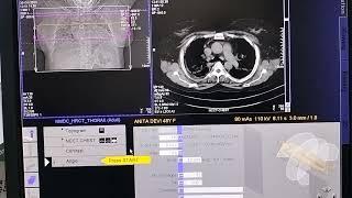 pulmonary angiography without pressure injector