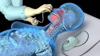 Nasotracheal suctioning (NTS) - 3D animation