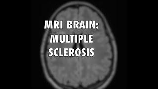 Multiple Sclerosis MRI