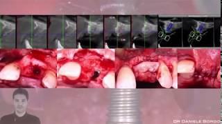 Hard and Soft Tissue reconstruction by Dr Daniele Bordonali