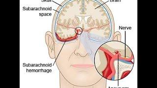 Subarachnoid Hemorrhage