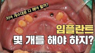 임플란트 상식) 임플란트는 치아갯수만큼 해야될까?