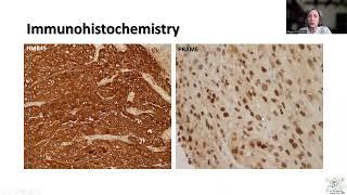 Tip-7; PRAME in MM vs. Clear Cell Sarcoma