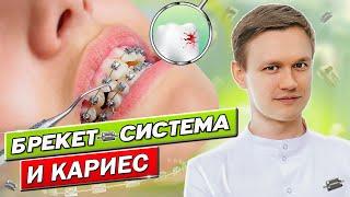 Брекет система и кариес / Как ухаживать за брекетами - чистка и гигиена