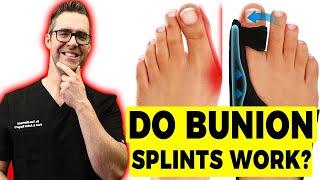 Do Bunion Correctors Work? [How To SHRINK Bunions Naturally!]