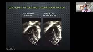 Dr Zoltan Molnar - Vasopressin in PHT - 06 05 22