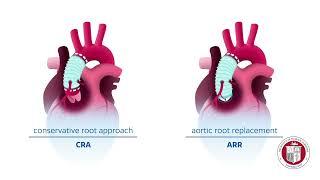 The Aortic Root in Acute Type A Dissection: Repair or Replace?