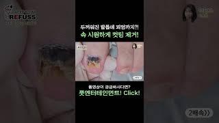 두꺼워진 발톱에 피멍까지?? 속 시원하게 컷팅 제거!! #레푸스 #일산레푸스 #내성발톱 #무좀발톱 #ingrown_toenail #일산내성발톱 #일산무좀발톱 #발톱