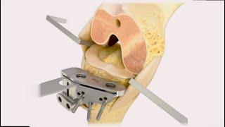 Step-by-Step Approach to Total Knee Replacement