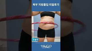 복부 지방흡입 7일차 리얼 후기!(feat.멍이 적게 드는 특별한 방법) #지방흡입