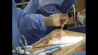 Coronary Bypass Surgery - MedStar Union Memorial