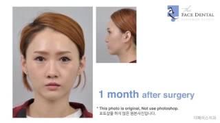 더페이스치과 양악수술(Double jaw surgery Before & After)