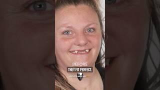 I Got Veneers And My Confidence Skyrocketed! Real Client Review
