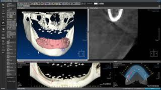 Full Edentulous I A Nerve Generation