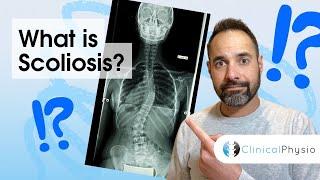 What is Scoliosis? | Expert Physio Explains