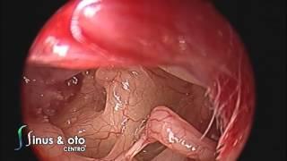 Low Flow Perilymphatic Fistula