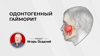 Одонтогенный или стоматологический гайморит