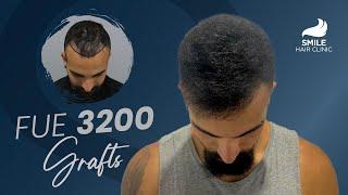 Hair Transplant - 3200 Grafts Transformed: 12-Month Journey | Before & After Reveal