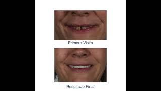 Enfermedad periodontal avanzada en ambas arcadas.