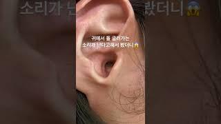 고막을 덮은 마른 귀지?!! #귀지 #귀지제거 #마른귀지 #귀파기 #귓밥 #耳掃除 #earwax #귀청소 #왕귀지 #earcleaning