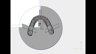 Zhiyin Fixutre Added to 3 SHAPE Orthoanalyzer Demostration