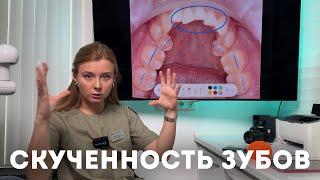 Скученность зубов — что делать, когда зубам нет места в зубном ряду?