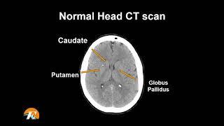 Normal Head CT Scan Anatomy Made Simple- Neuroradiology