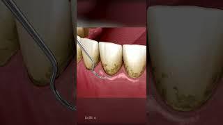 AMSR Tarter Removal: Dental Cleaning to Remove Plaque & Tarter Buildup