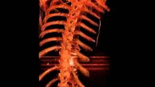 Thoracotomy for Exposure of the Spine