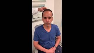 One Year After a 2,000 FUE Hair Transplant | Dr. Anthony Bared, MD, FACS Miami, FL