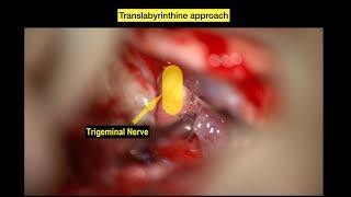  Recurrent/Residual Vestibular Schwannoma Presenting with Trigeminal Neuralgia 