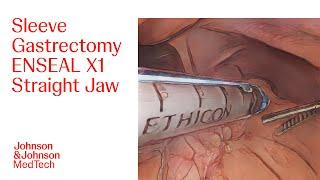 Performing a Sleeve Gastrectomy with ENSEAL X1 Straight Jaw | J&J MedTech