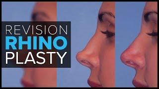 Non Surgical Revision Rhinoplasty in San Francisco